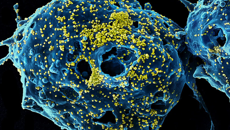 ویروس کرونا با ریه‌ها چه می‌کند؟